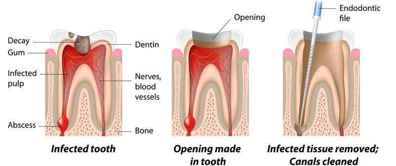 Root Canal Part 1