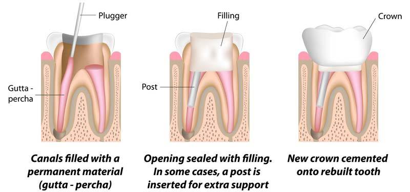 Root Canal Part 2